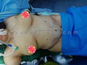 Abdominoplasty Surgery