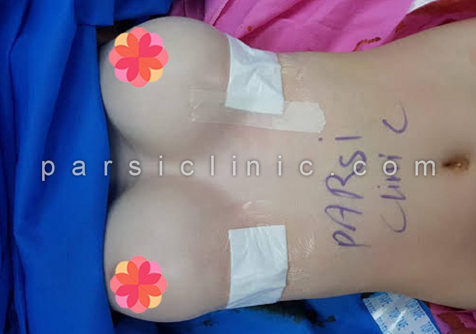 Breast Augmentation Implant in Iran 