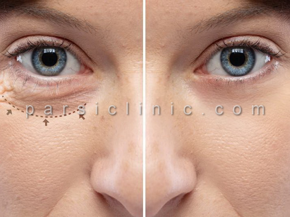 Eyelid and Eyebrow Cosmetic Surgery